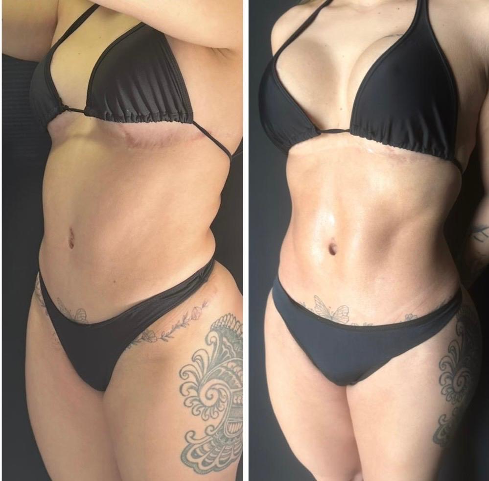 Resultado de lipoaspiração Ultra HD com cintura e abdome definidos